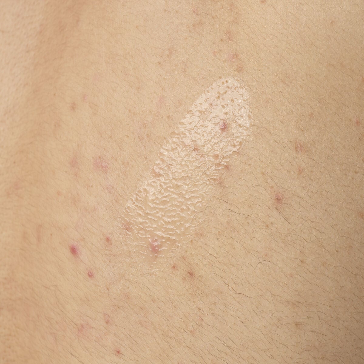 salicylic-acid-0-5-body-serum-c8 ORD-salicylic-acid-05-body-240ml-application.jpg