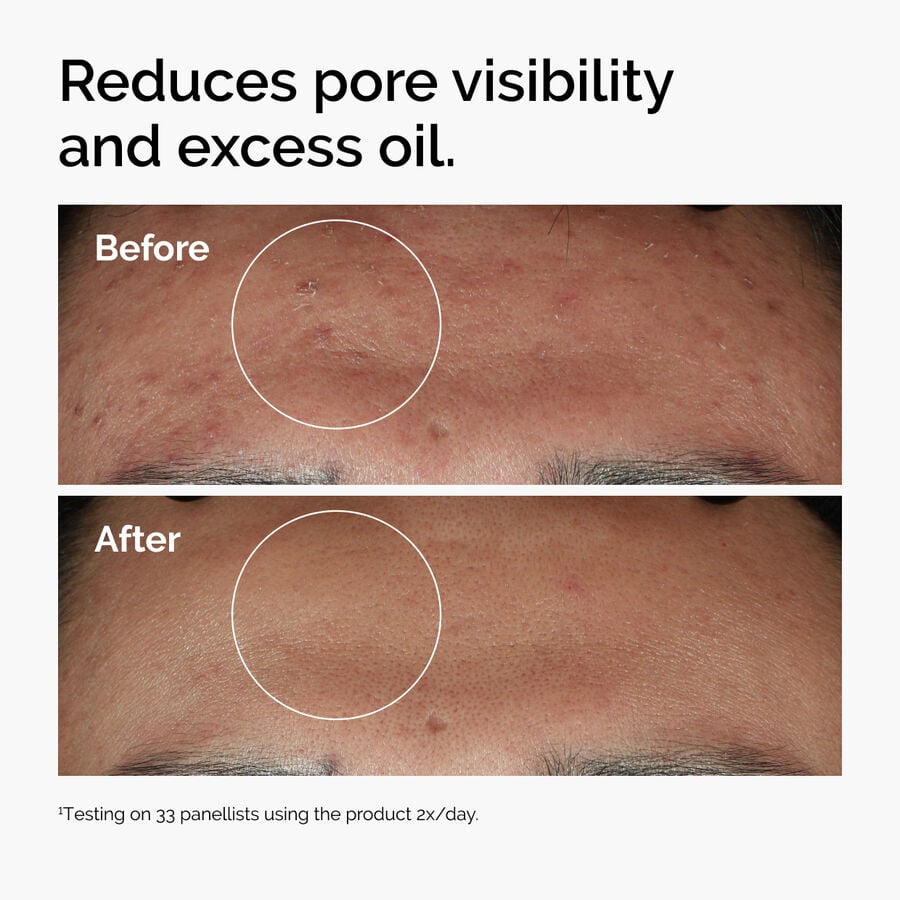 niacinamide-10-zinc-1-z9 ord-niacinamide-zinc-blemish-serum-before-after-pores.jpg