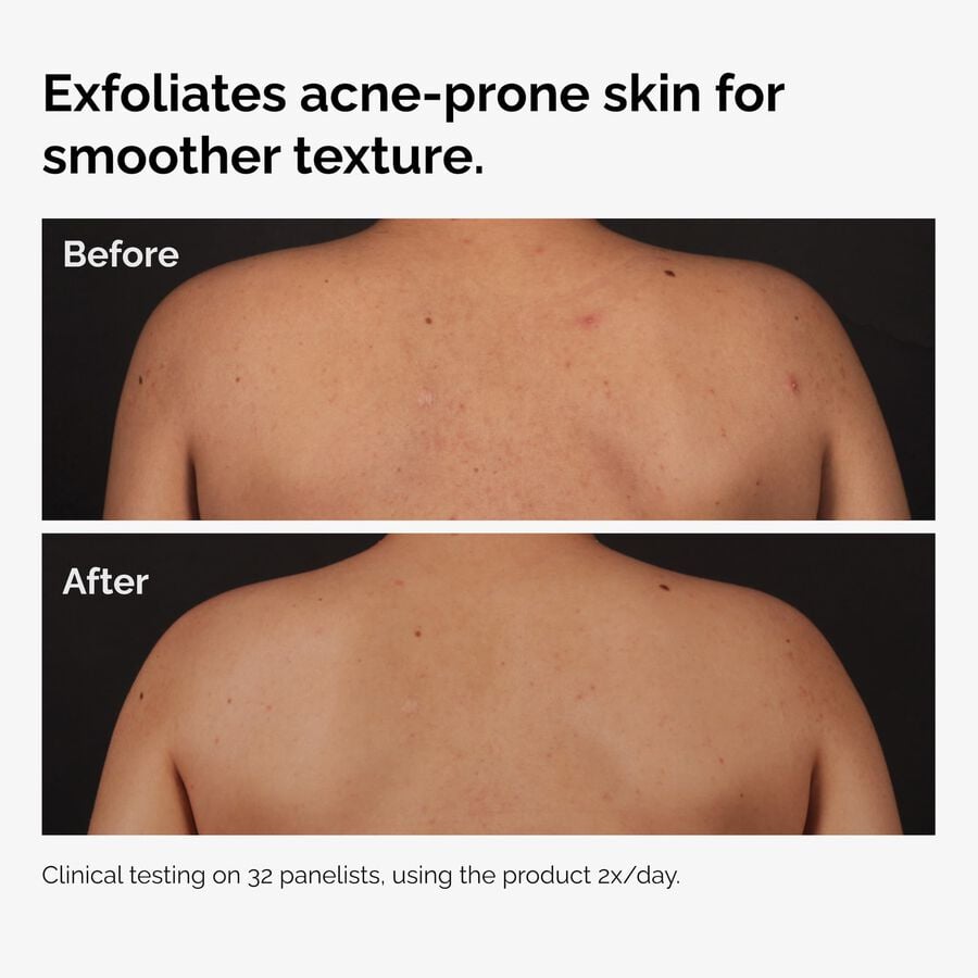 salicylic-acid-0-5-body-serum-c8 ord-salicylic-acid-body-serum-before-after-graphic-NA.jpg