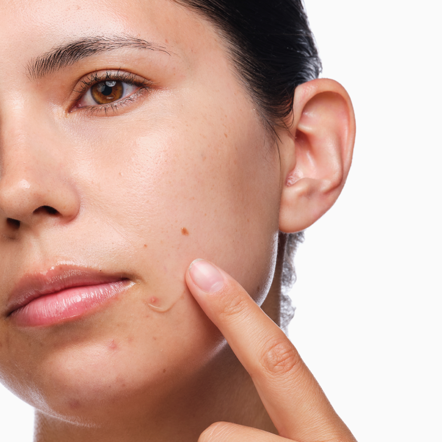 the-acne-set-z1 rdn-the-acne-set-application.png